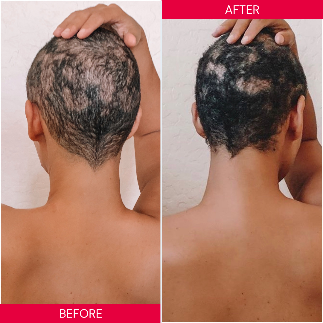 Best Hairloss Treatment for Men before and after