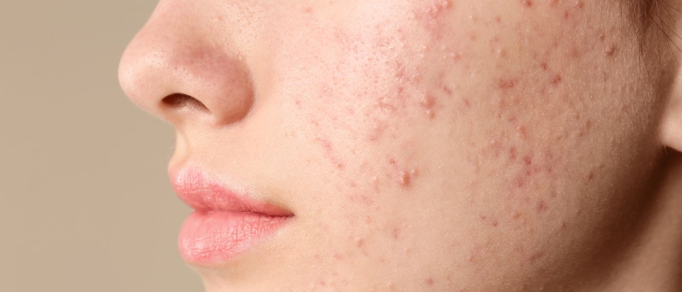 5 Things That Are Secretly Causing Acne Breakouts